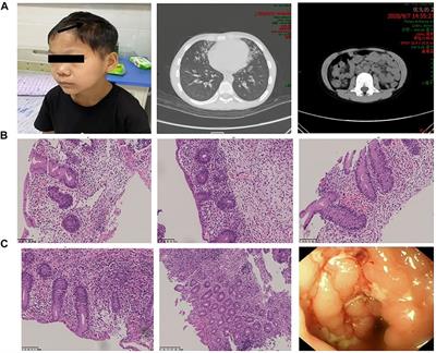 Renal Involvement in IPEX Syndrome With a Novel Mutation of FOXP3: A Case Report